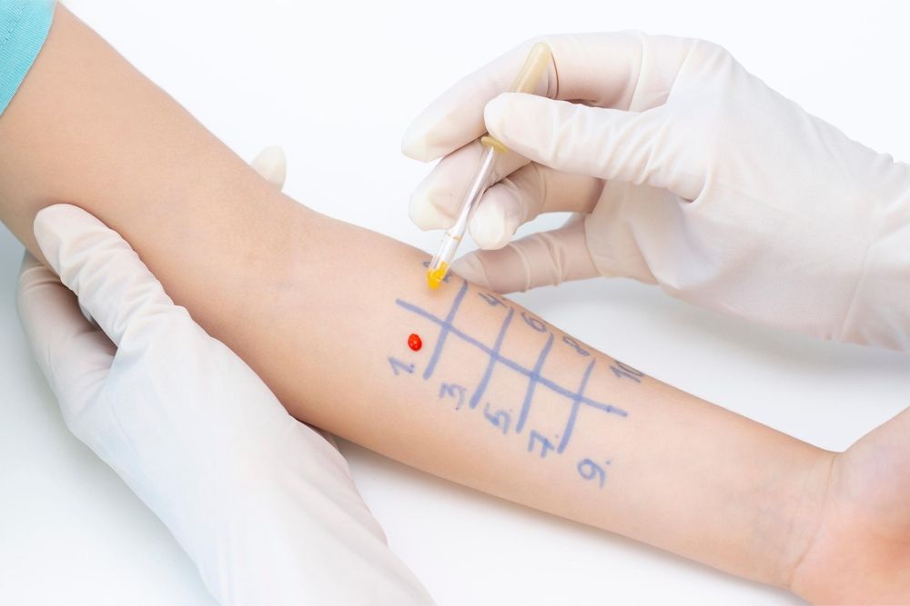 Arm mit aufgemaltem Raster für Pricktest, medizinische Hand trägt Handschuhe und trägt Tropfen auf die Haut auf
